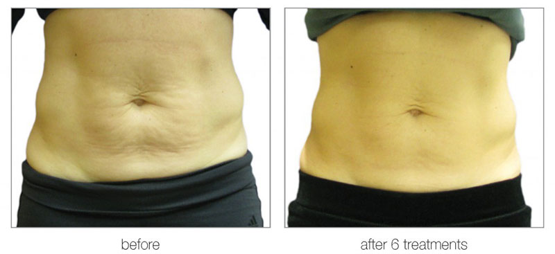 Aesthetic Treatments in Ilford | | i-lipo London gallery image 23