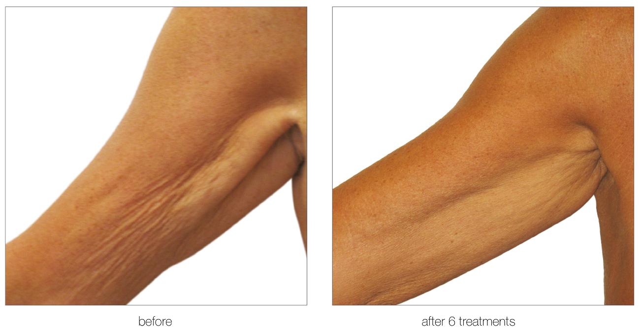 Aesthetic Treatments in Ilford | | i-lipo London gallery image 9