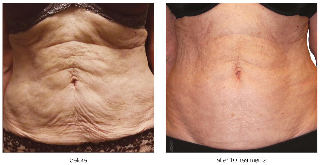 Aesthetic Treatments in Ilford | | i-lipo London gallery image 18