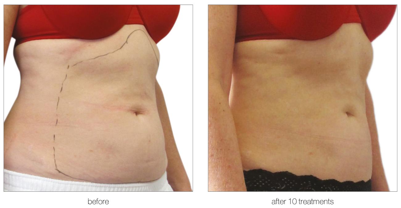 Aesthetic Treatments in Ilford | | i-lipo London gallery image 15