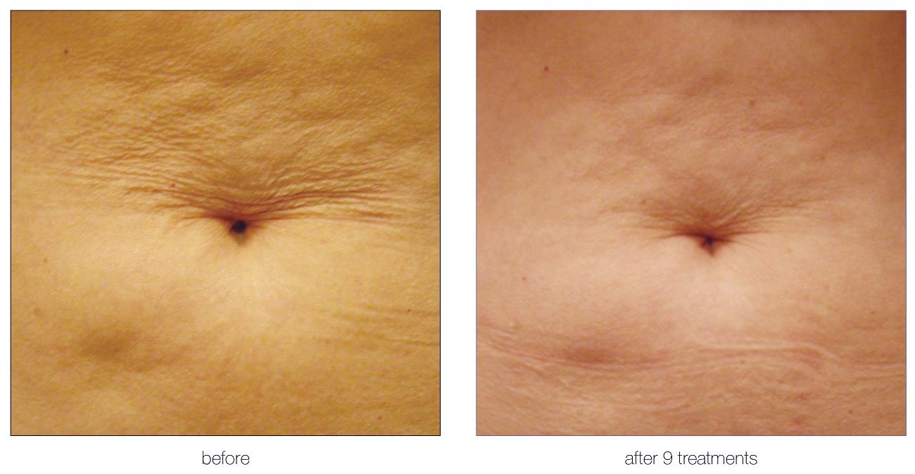 Aesthetic Treatments in Ilford | | i-lipo London gallery image 14