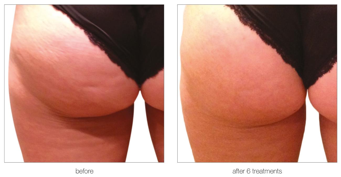 Aesthetic Treatments in Ilford | | i-lipo London gallery image 7
