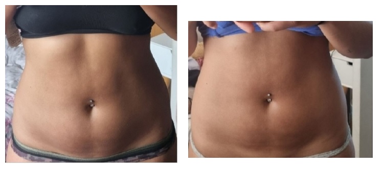 Aesthetic Treatments in Ilford | | i-lipo London gallery image 31
