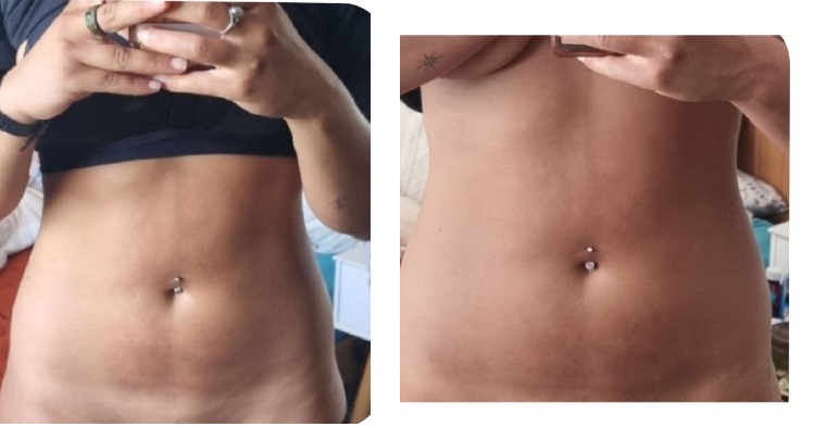 Aesthetic Treatments in Ilford | | i-lipo London gallery image 30