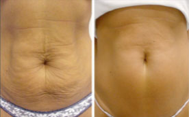 Lymphatic Drainage | Non Invasive Beauty Treatments London gallery image 1