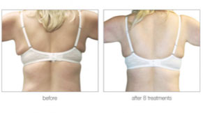 Lymphatic Drainage | Non Invasive Beauty Treatments London gallery image 3