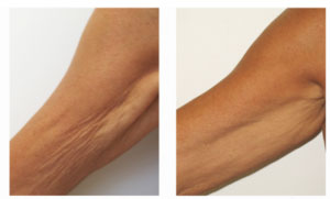 Lymphatic Drainage | Non Invasive Beauty Treatments London gallery image 2