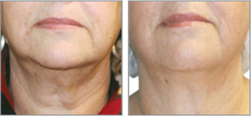 Face, Jawline and Neck Lift | Non Invasive Beauty Treatments London gallery image 1