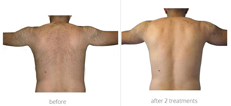Aesthetic Treatments in Ilford | | i-lipo London gallery image 21