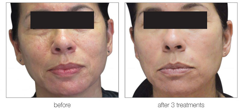 Radio Frequency Face Treatment | Non Invasive Beauty Treatments London gallery image 2